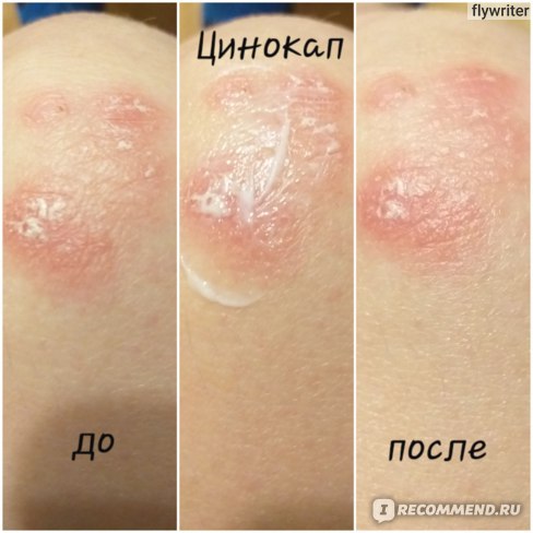 Цinocap, 0,2%, ахро -холб дл.